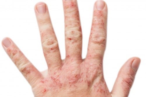 Qui des gens connus a un psoriasis