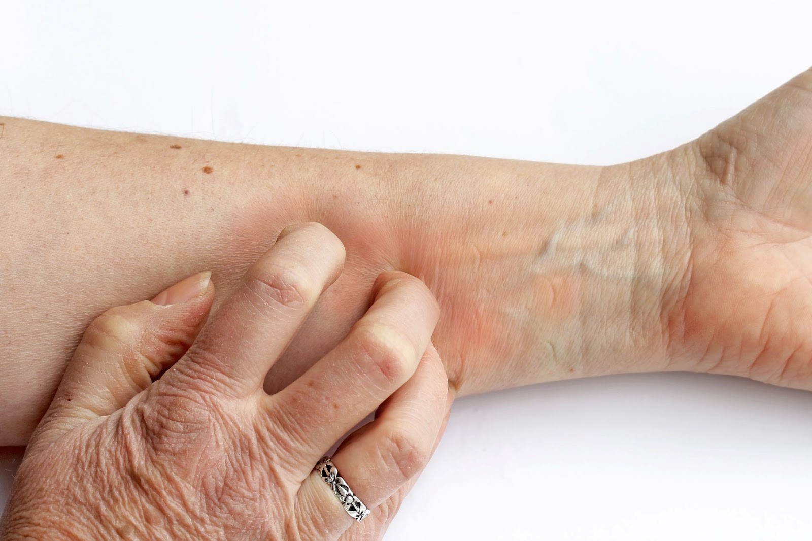 La dyshidrose : une maladie de peau des mains et des pieds particulièrement  douloureuse - Association Française de l'eczéma